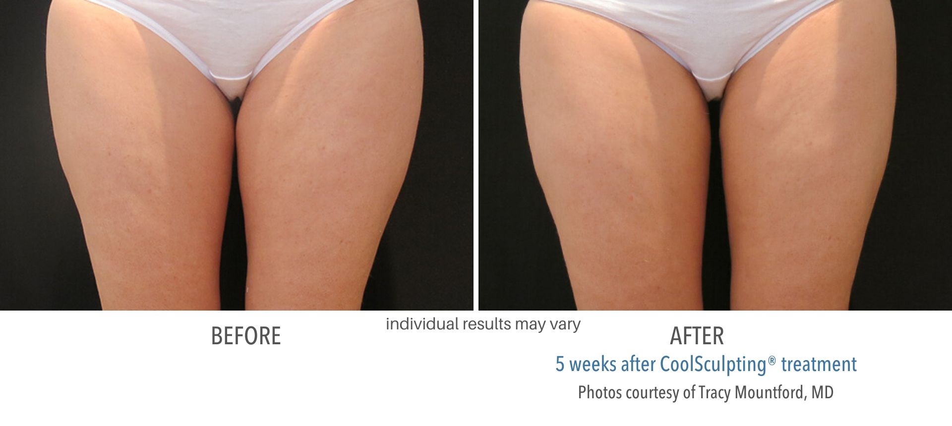 COOLSCULPTING | FAT FREEZING | BODY CONTOURING