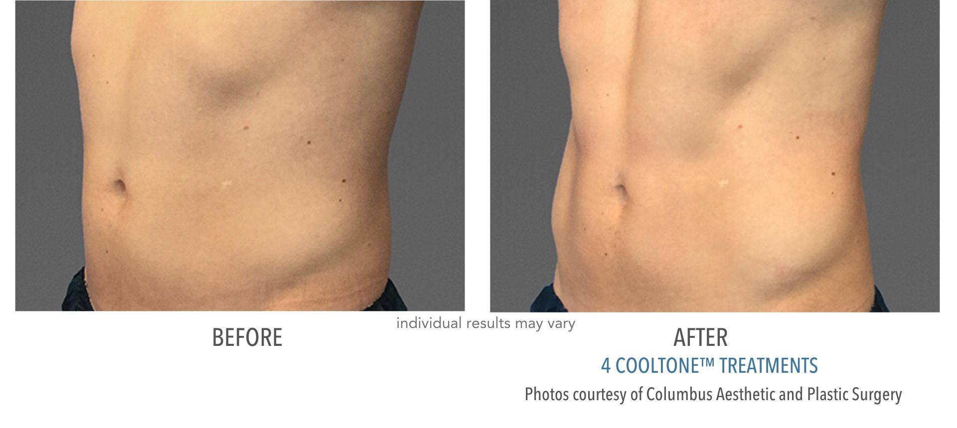 cooltone before and after abdomen male