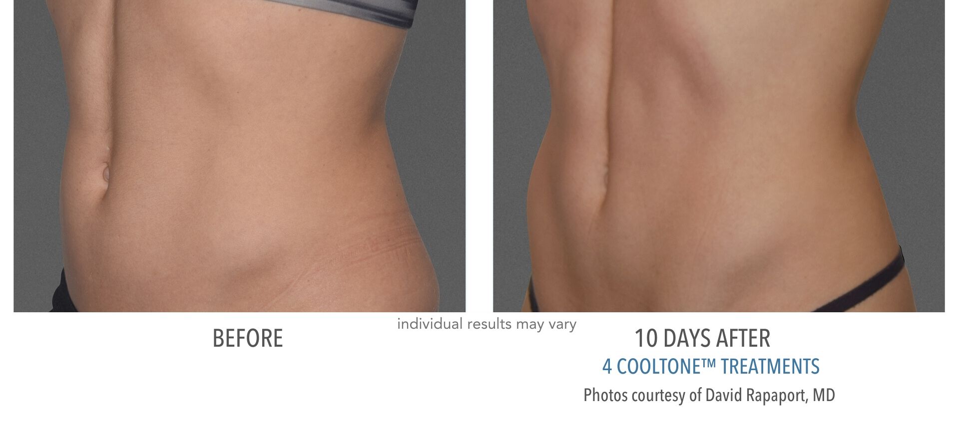 cooltone before and after abdomen female