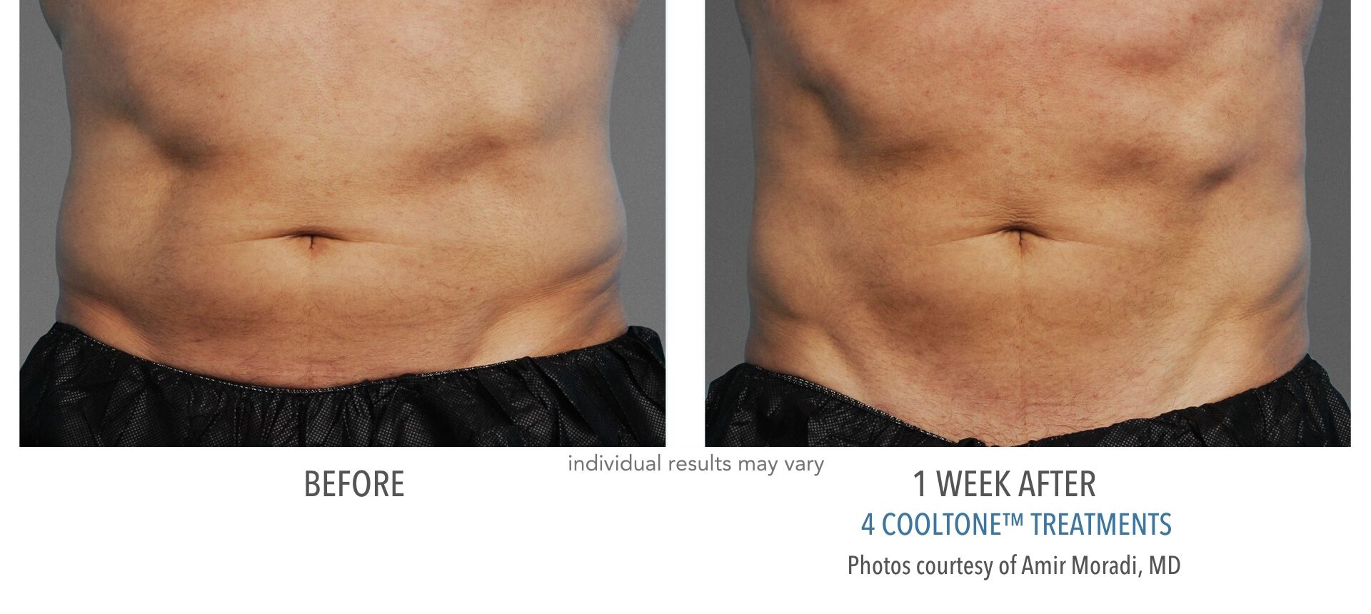 cooltone before and after abdomen