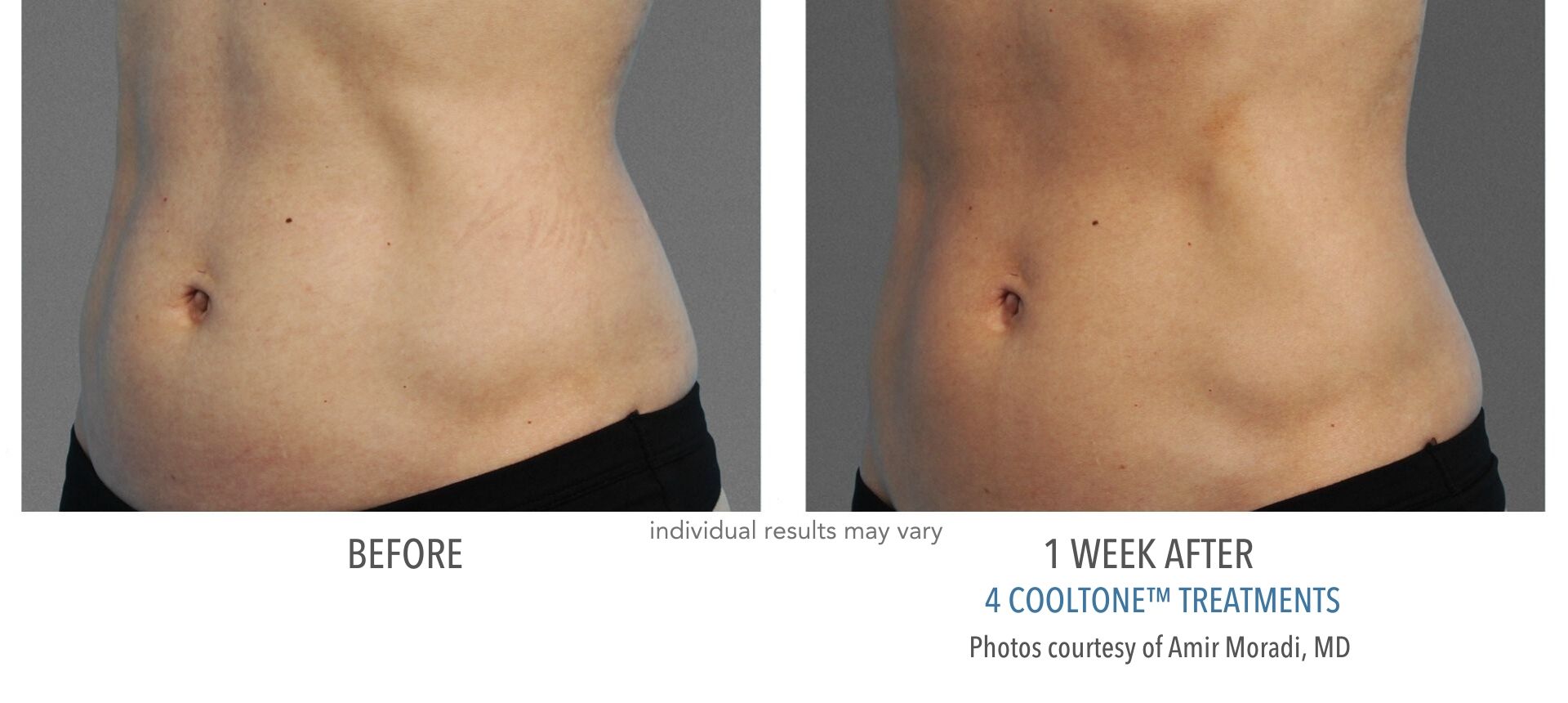 CoolTone transformations abdomen