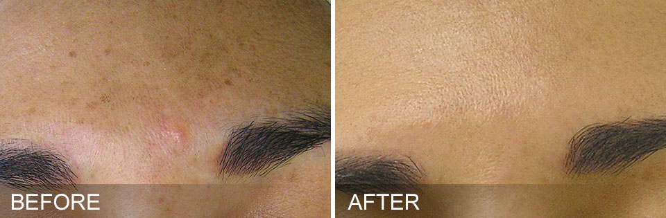 hydrafacials before and after for brownspots