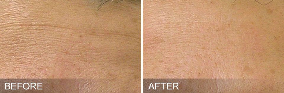 hydrafacials before and after for finelines