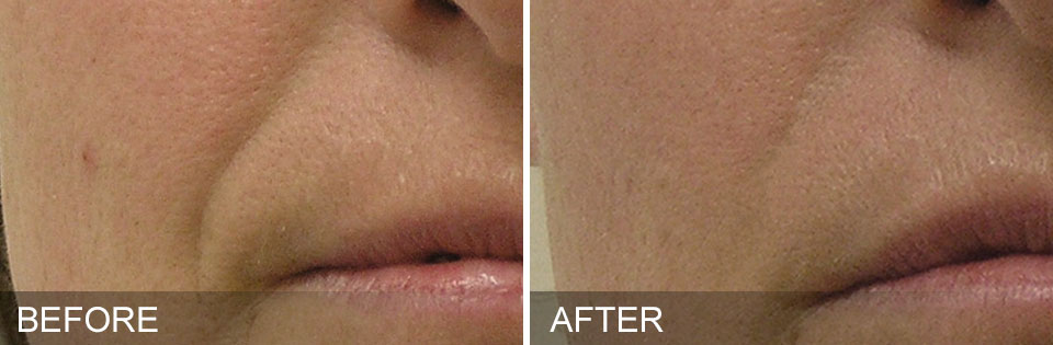 hydrafacials before and after for nasolabial folds