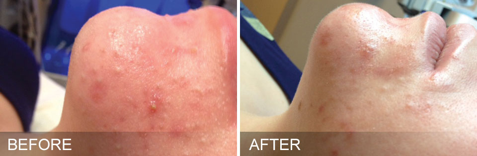 hydrafacials before and after for oily congested