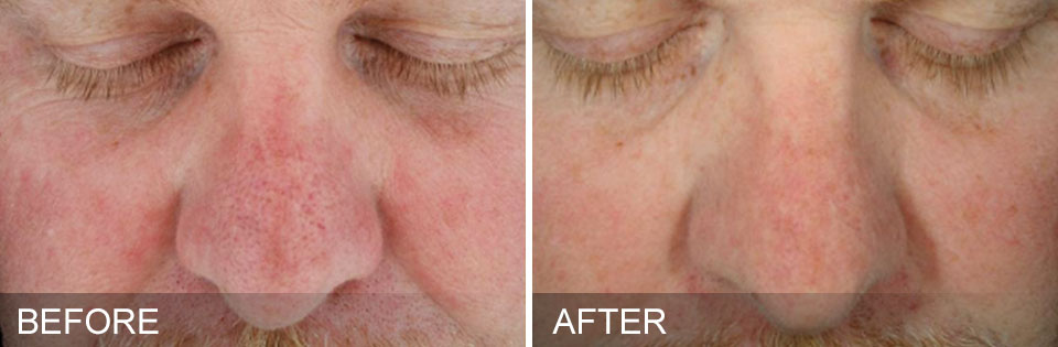 hydrafacials before and after for Sun Damage