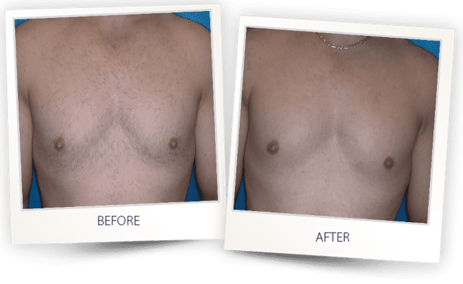 Laser hair removal in Delaware County PA