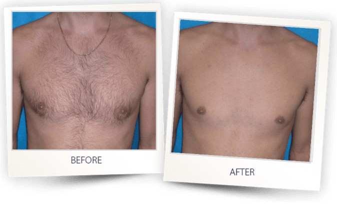 Laser hair removal in KP Aesthetics PA