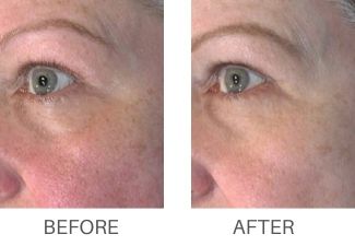 vivace microneedling before and after Westchester