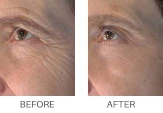 vivace microneedling before and after Glen Mills