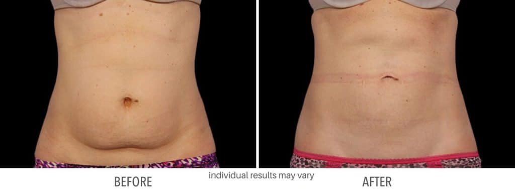 CoolSculpting before and after