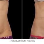 CoolSculpting before and after