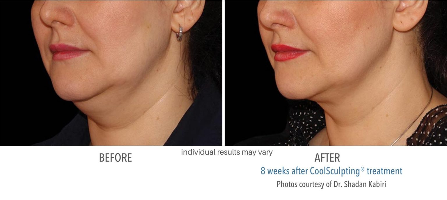 coolsculpting_before_and_after_kpaesthetics_NewtownSquare_1-1536x688