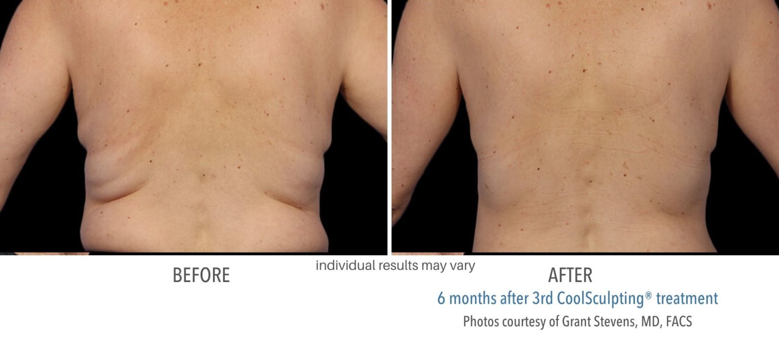 coolsculpting_before_and_after_kpaesthetics_NewtownSquare_11-1536x688