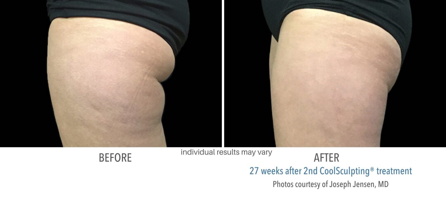 coolsculpting_before_and_after_kpaesthetics_NewtownSquare_12-1536x688