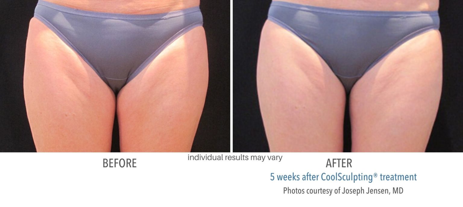 coolsculpting_before_and_after_kpaesthetics_NewtownSquare_13-1536x688