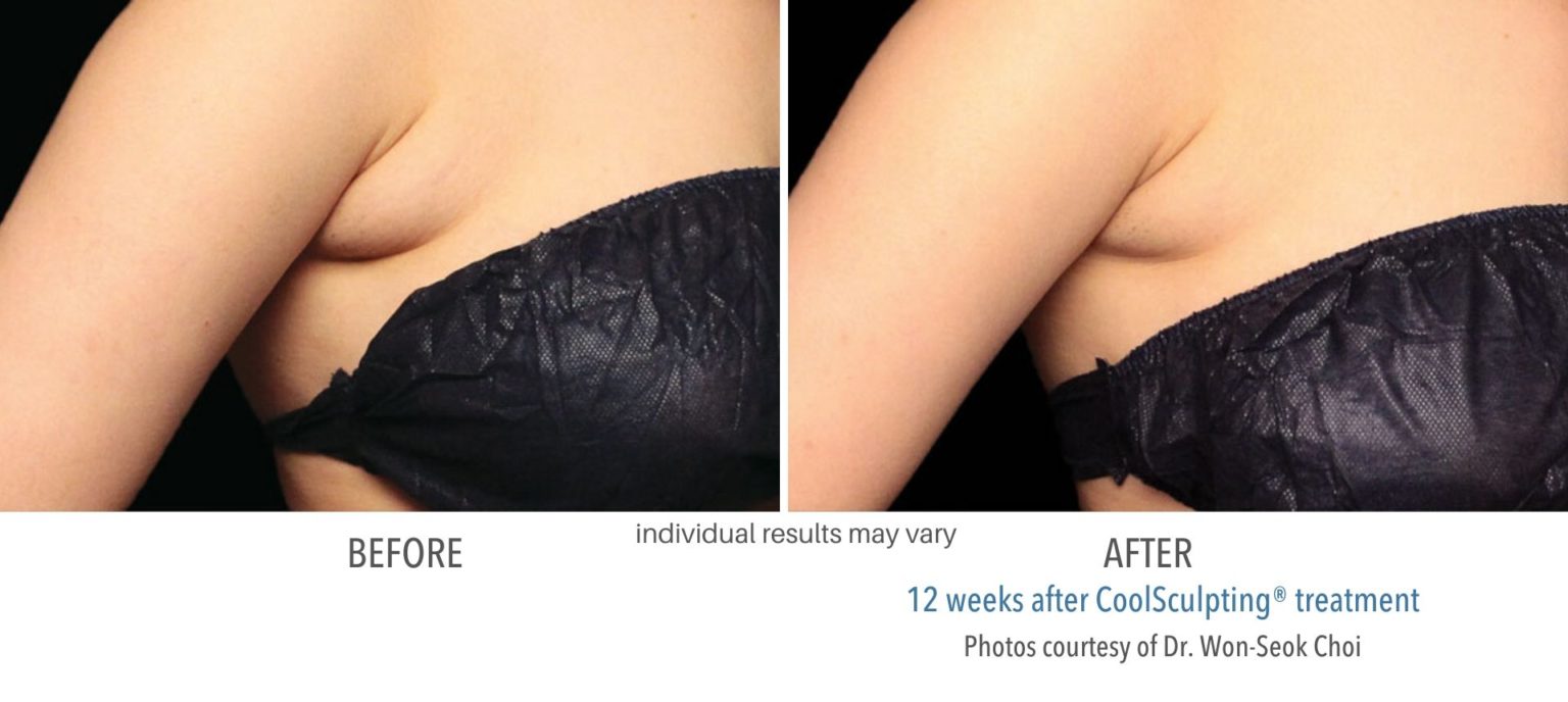 coolsculpting_before_and_after_kpaesthetics_NewtownSquare_3-1536x688