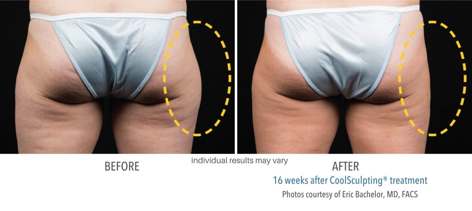 coolsculpting_before_and_after_kpaesthetics_NewtownSquare_6-1536x688
