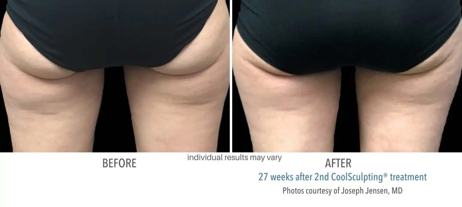 coolsculpting_before_and_after_kpaesthetics_NewtownSquare_7-1536x688 (1)