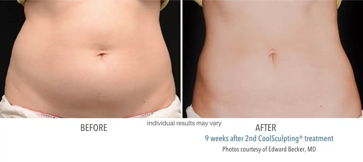 coolsculpting_before_and_after_kpaesthetics_NewtownSquare_8-1536x688