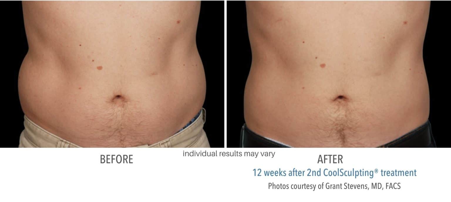 coolsculpting_before_and_after_kpaesthetics_NewtownSquare_9-1536x688