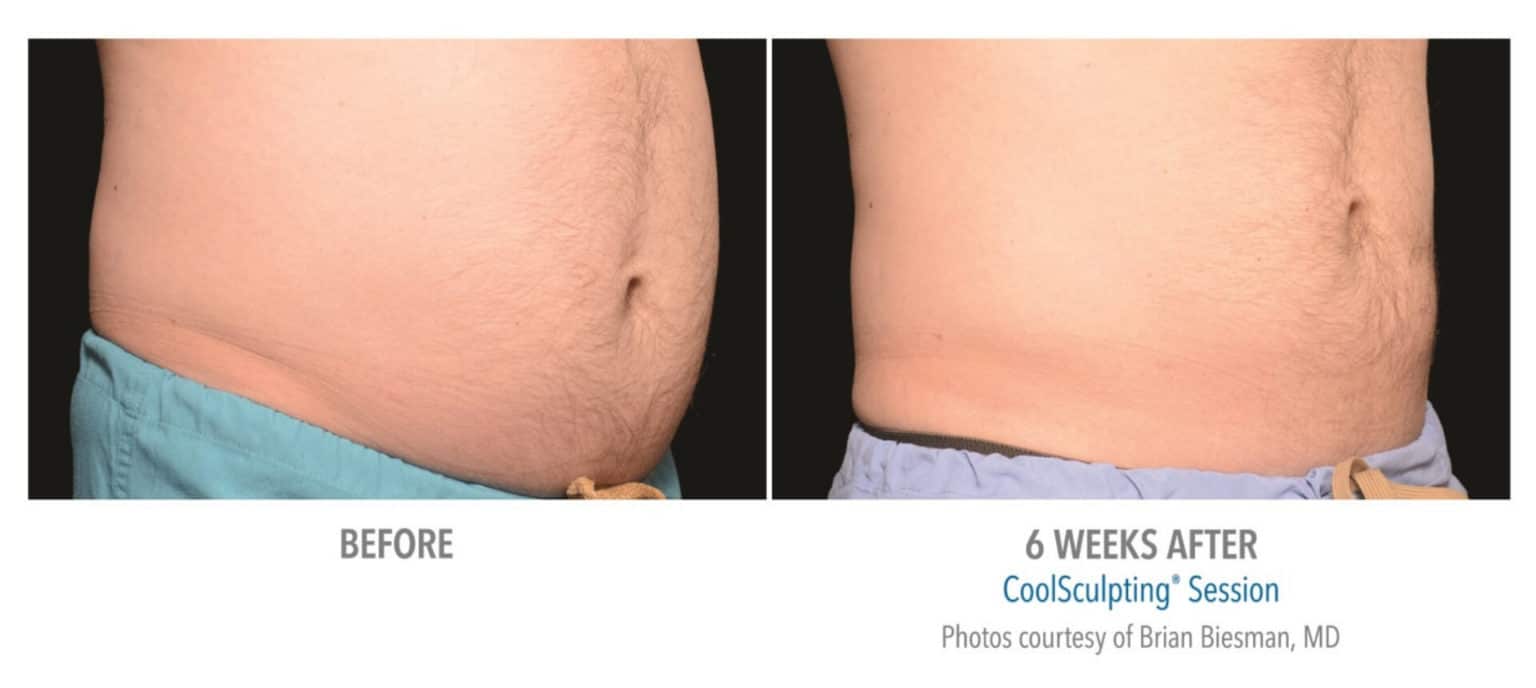 Man's abdomen before and after coolsculpting treatment.