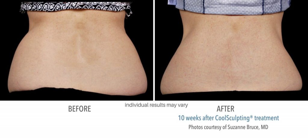 womans back fat before and after coolsculpting treatment.