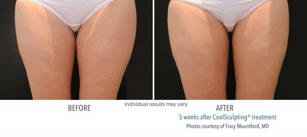Woman's inner thigh fat before and after coolsculpting treatment.