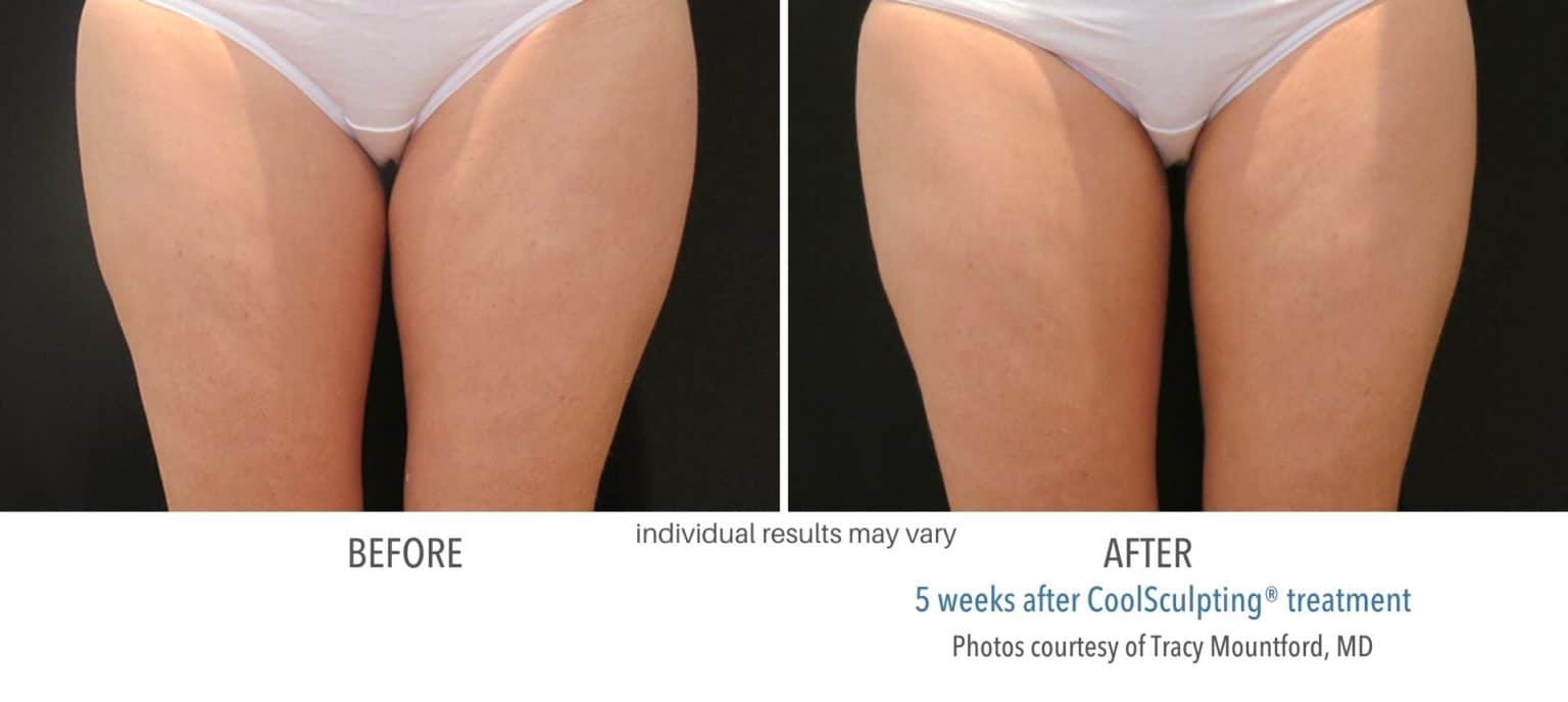 coolsculpting_before_and_after_newtown_square_5-1-1536x688