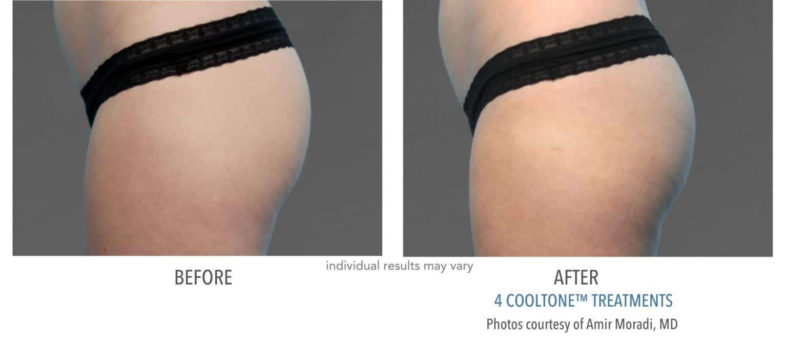 Woman's buttocks before and after cooltone treatment at KP Aesthetics in Newton Square, PA.