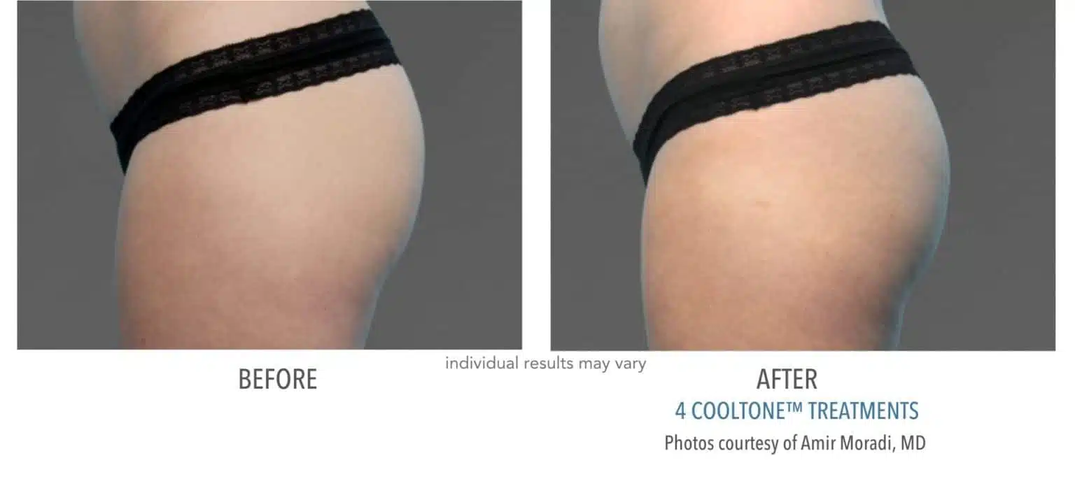 Woman's buttocks before and after cooltone treatment at KP Aesthetics in Newton Square, PA.