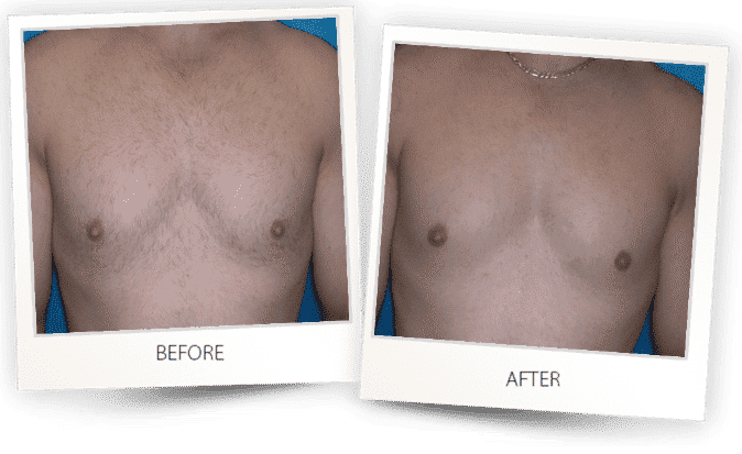 chest of a man before laser hair removal and after