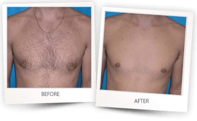 before and after laser hair removal newtown square, pa at kp aesthetics