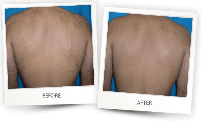 before and after laser hair removal newtown square, pa at kp aesthetics