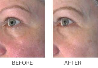 Before and after results from microneedling treatment at KP Aesthetics.