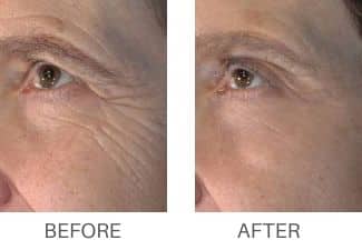 Before and after results from mironeedling treatment at KP Aesthethics.