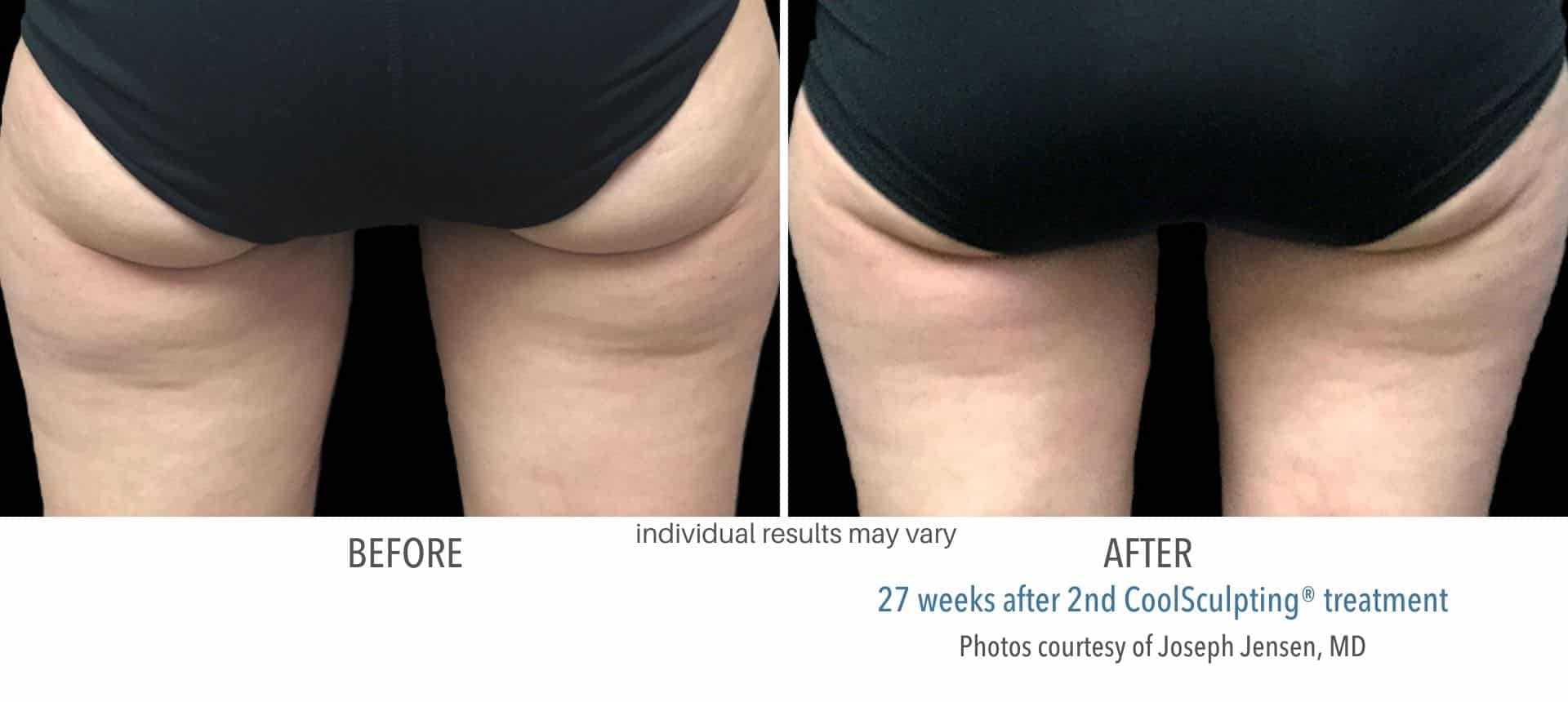 CoolSculpting_Thighs