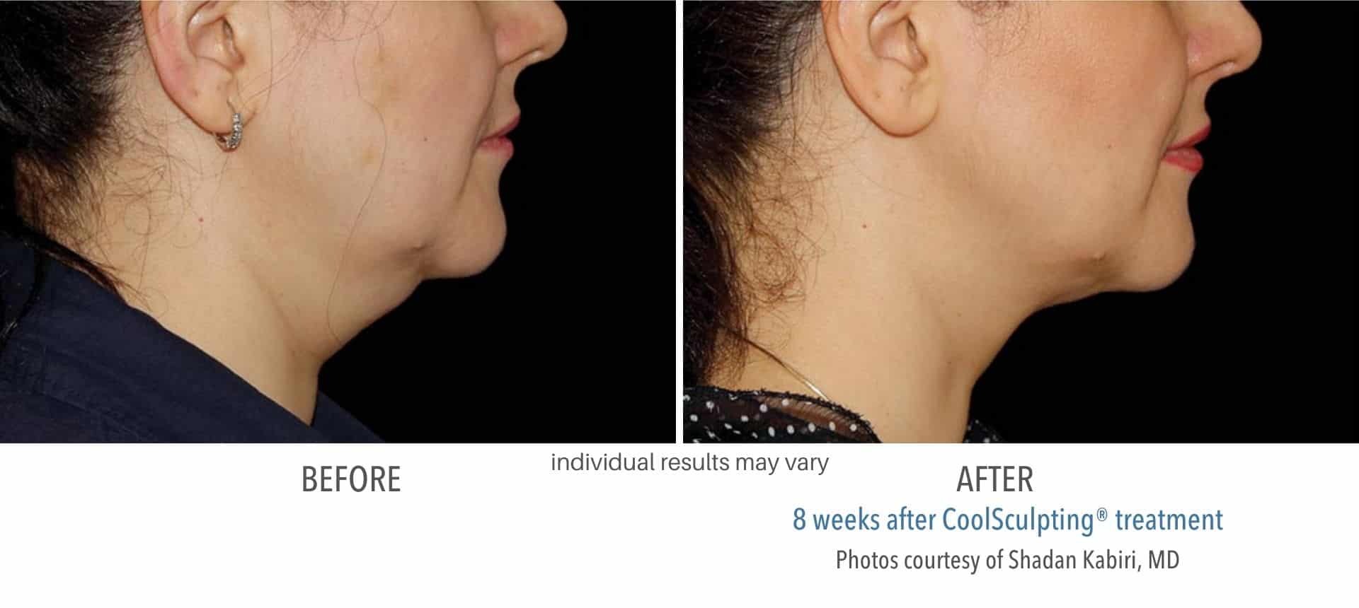 Woman's chin before and after coolsculpting treatment.