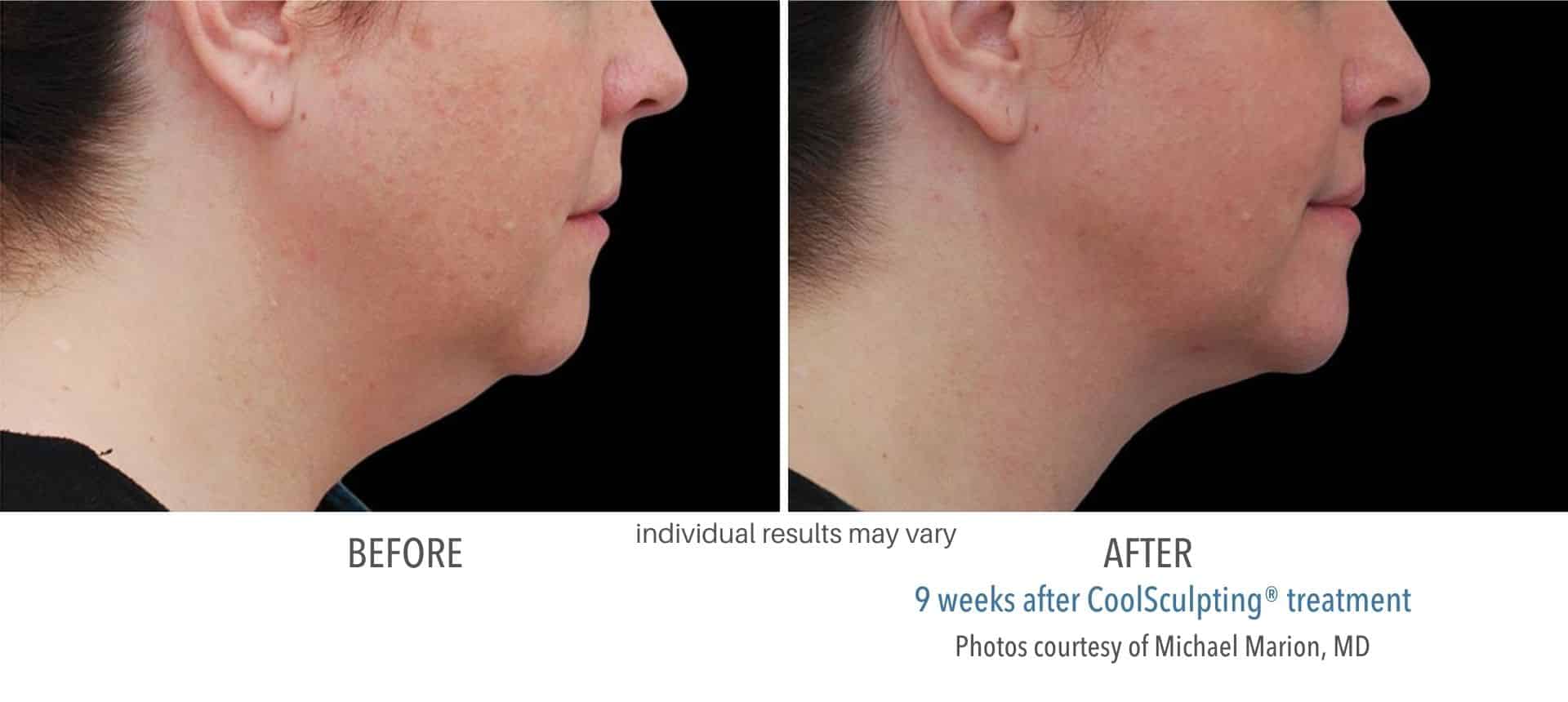 Woman's chin before and after coolsculpting treatment.