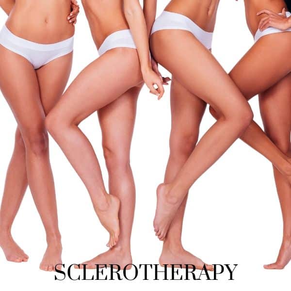 sclerotherapy treatment for spider veins.