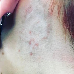 Tattoo nearly gone after laser tattoo removal.
