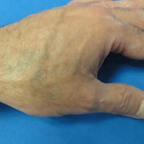 hand tattoo after laser tattoo removal.