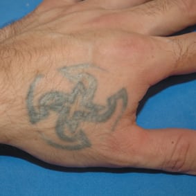 Hand tattoo before.