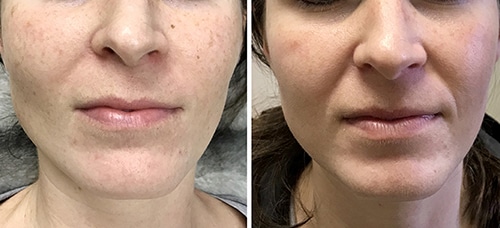 Womans before and after IPL treatment.
