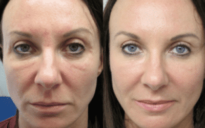Woman's before and after laser treatment on her face, with clearer and rejuvenated skin.