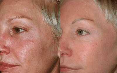 Woman before and after laser treatment with clearer skin.