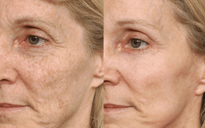 Woman before and after laser treatment with more youthful skin.