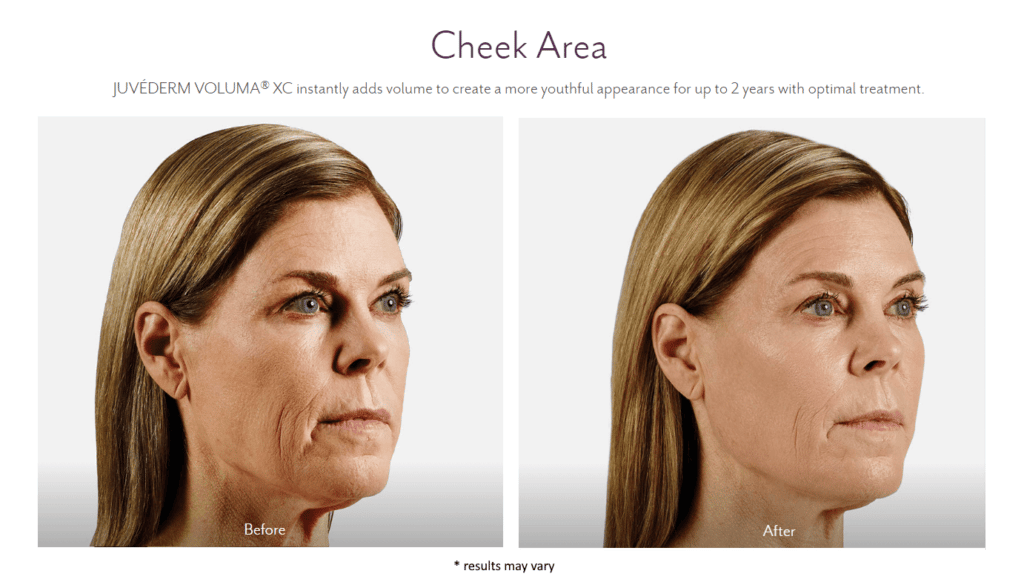 Woman's before and after dermal filler results.