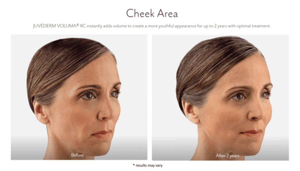 Woman's before and after dermal filler results.