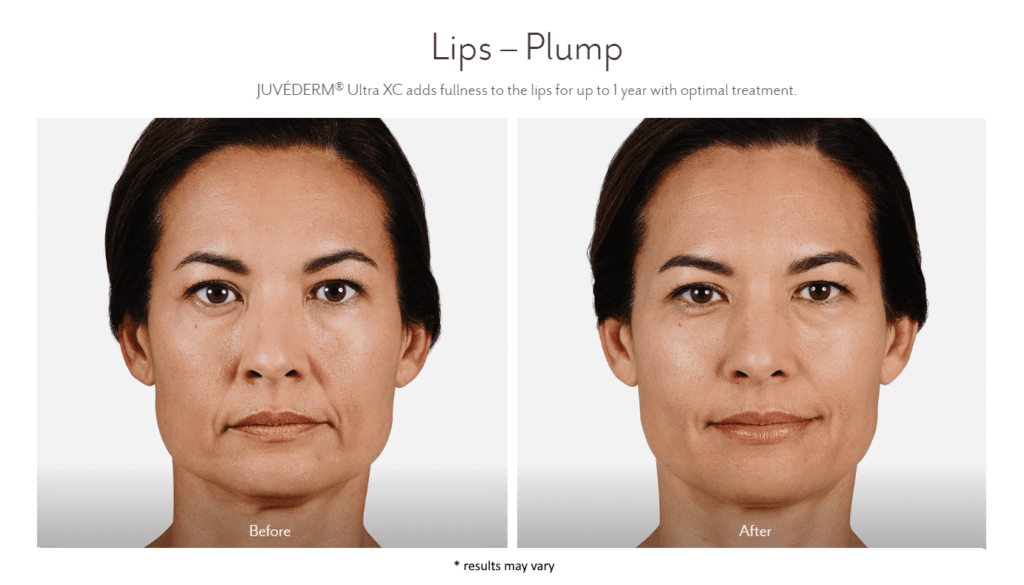 Woman's before and after dermal filler results.